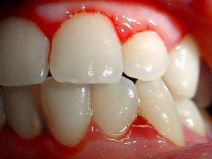 14 raisons pour lesquelles vos gencives saignent